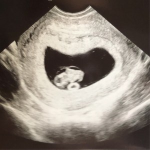 8 Week sonogram